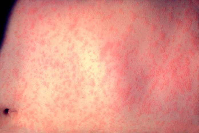 Alerta por aumento de casos de sarampión en el mundo - Itagüí Hoy